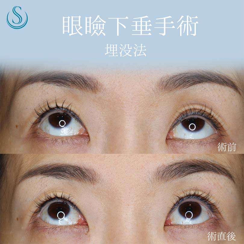 【40代女性・眼瞼下垂手術で目の開きを改善】眼瞼下垂（埋没法）（術直後） After 