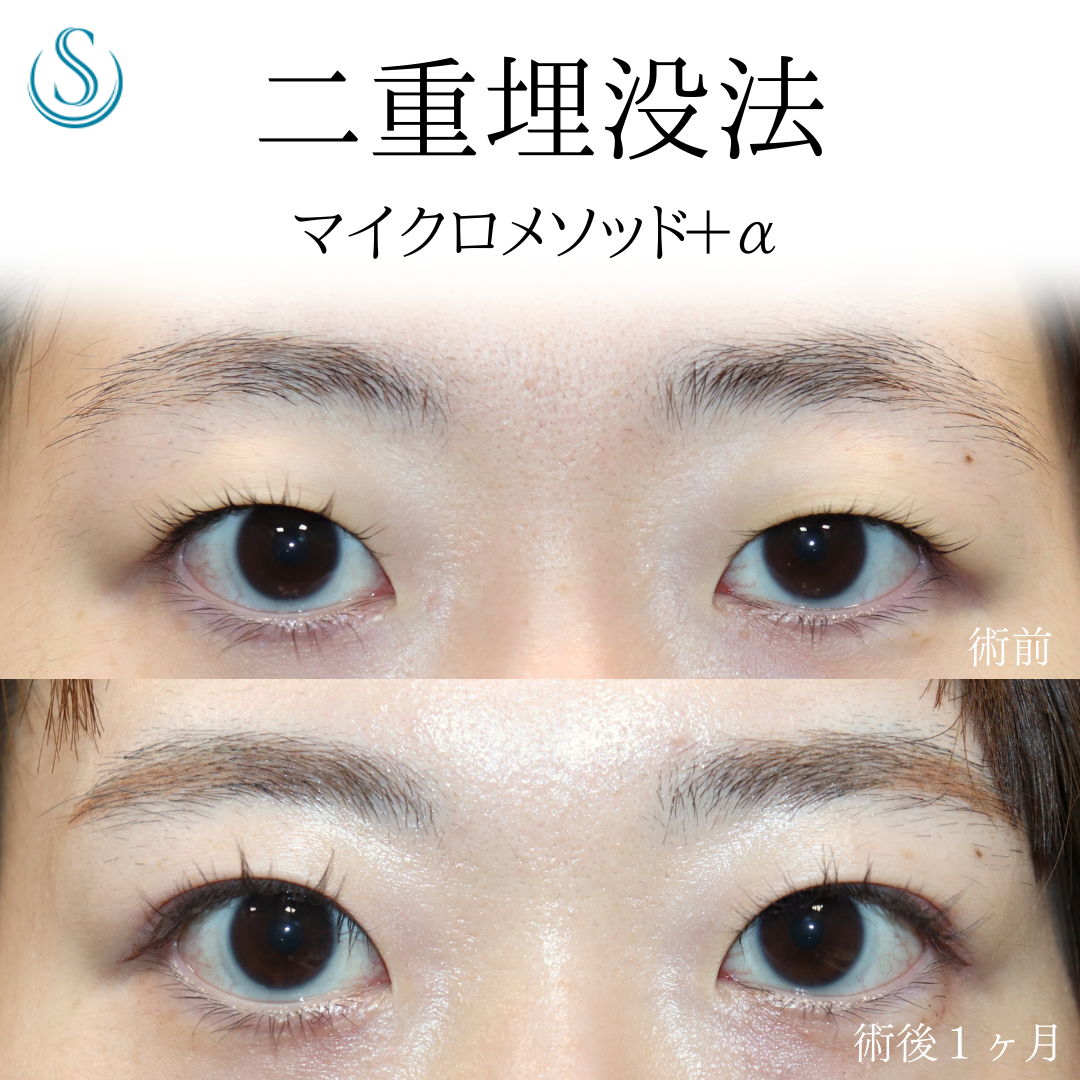 【20代女性・埋没法でぱっちり二重に】二重術（埋没法）：マイクロメソッド+α（術後1ヶ月） Before 