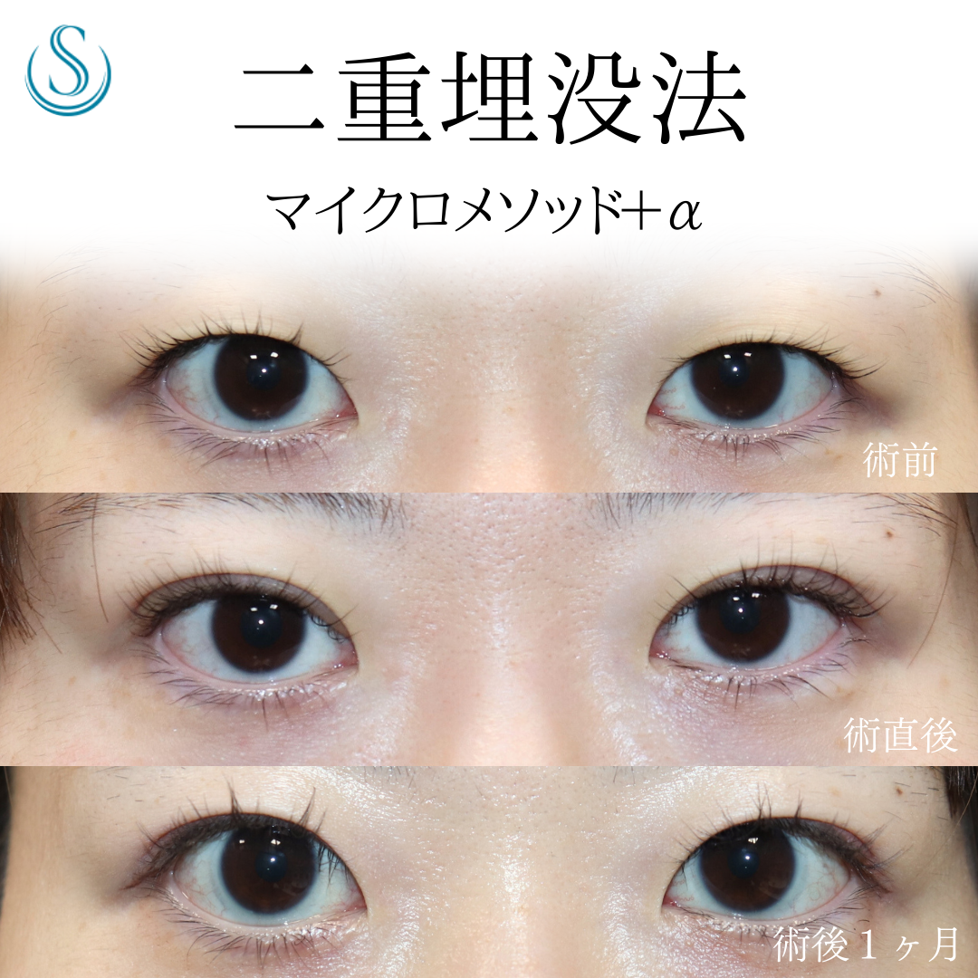 【20代女性・埋没法でぱっちり二重に】二重術（埋没法）：マイクロメソッド+α（術後1ヶ月） After 