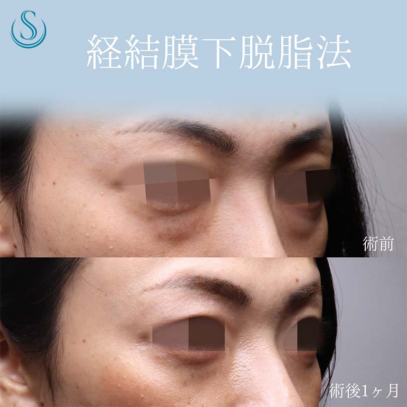 【30代女性・クマ取りで目の下をすっきり】目の下の脂肪取り（経結膜下脱脂法）（術後１ヶ月） After 