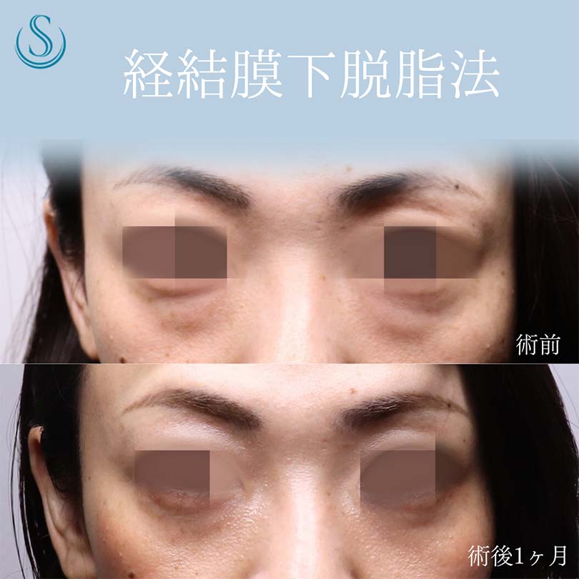 【30代女性・クマ取りで目の下をすっきり】目の下の脂肪取り（経結膜下脱脂法）（術後１ヶ月） Before 