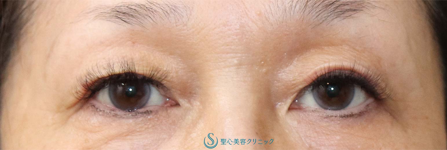 【60代女性・加齢による二重の被りを埋没法で自然にスッキリ】二重マイクロメソッド埋没法（1か月後） Before 