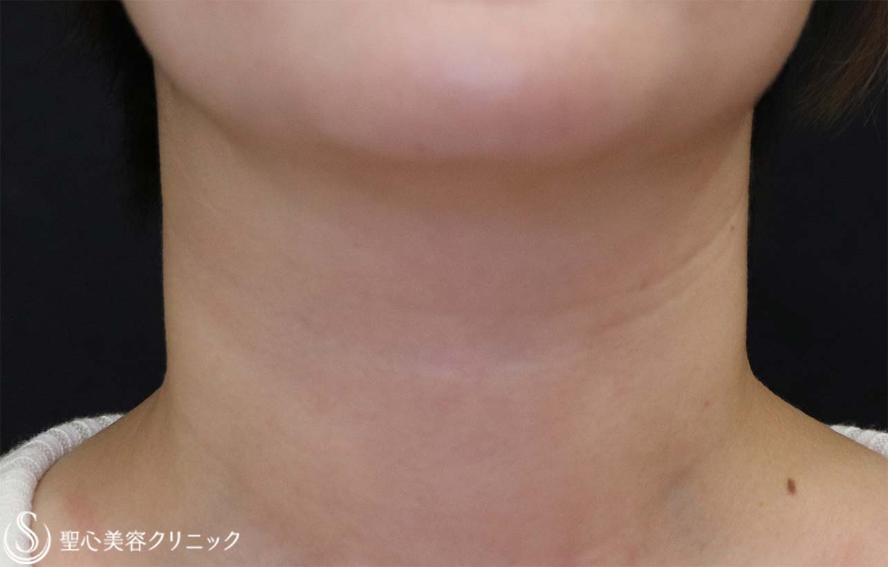 【20代女性・首の横じわ】プレミアムPRP（2回注入後） After 