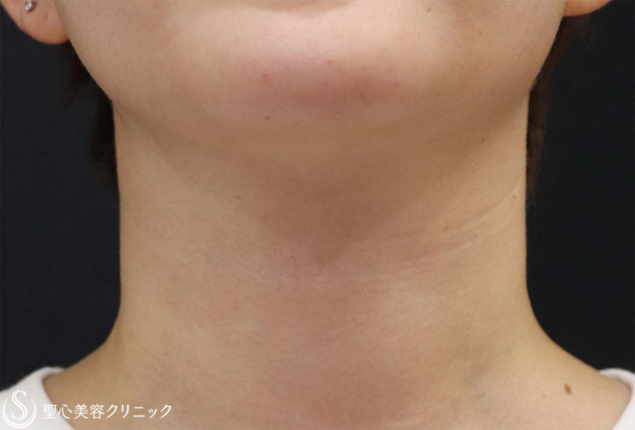 【20代女性・首の横じわ】プレミアムPRP（2回注入後） After 