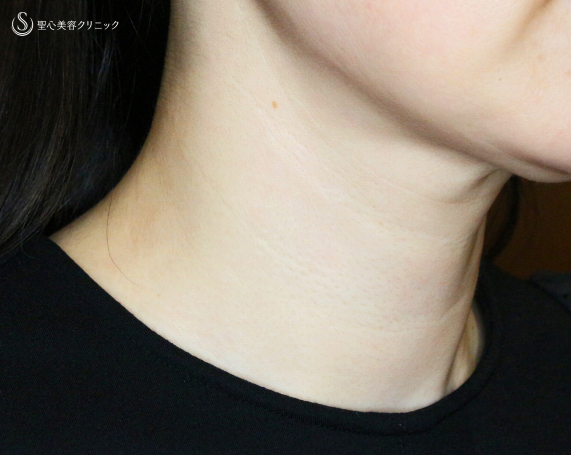 【40代女性・難易度の高い首の横ジワ】プレミアムPRP皮膚再生療法（4年4ヶ月後） After 