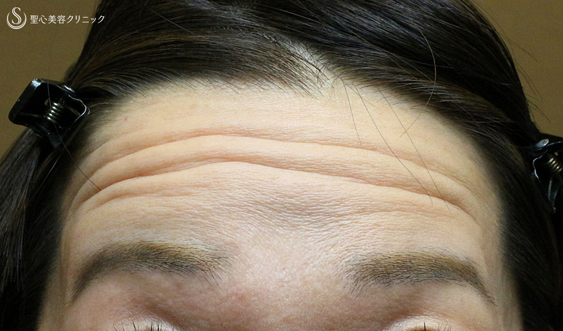 【50代女性・額＆こめかみの凹凸を丸く】プレミアムPRP皮膚再生療法（7年後） Before 
