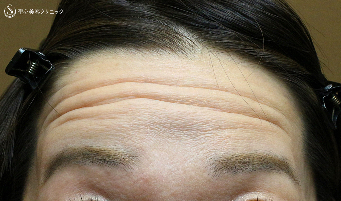 【50代女性・額＆こめかみの凹凸を丸く】プレミアムPRP皮膚再生療法（8年後） Before 