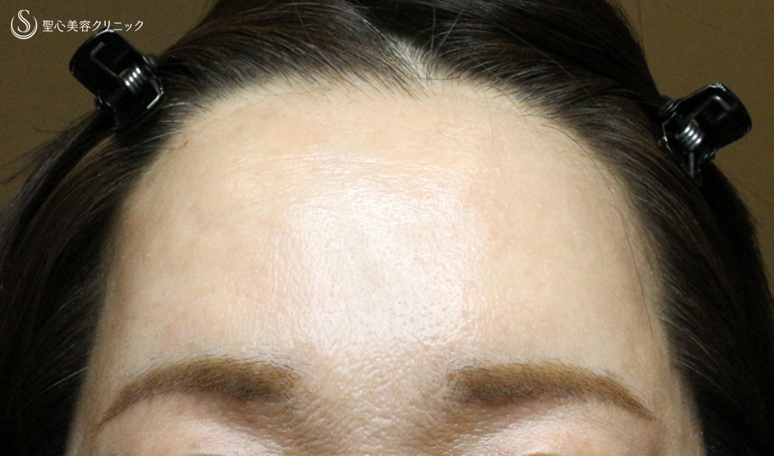 【50代女性・額＆こめかみの凹凸を丸く】プレミアムPRP皮膚再生療法（7年後） After 
