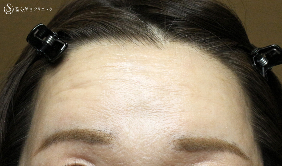 【50代女性・額＆こめかみの凹凸を丸く】プレミアムPRP皮膚再生療法（7年後） After 