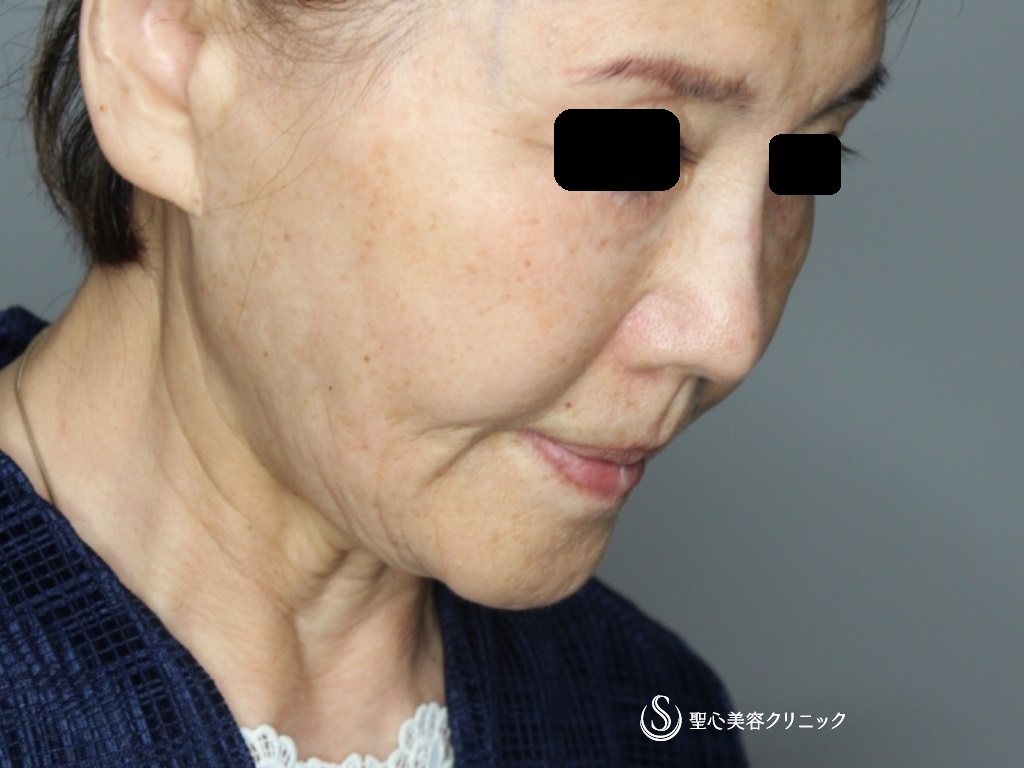 【70代女性・頬～顎下～首のたるみ治療】プレミアムミニリフト＋ネックリフト（術後1か月） Before 