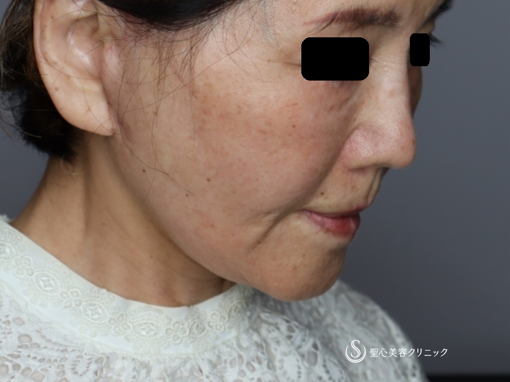 【70代女性・頬～顎下～首のたるみ治療】プレミアムミニリフト＋ネックリフト（術後1か月） After 