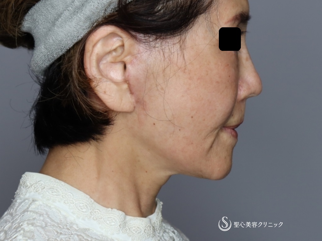 【70代女性・頬～顎下～首のたるみ治療】プレミアムミニリフト＋ネックリフト（術後1か月） After 