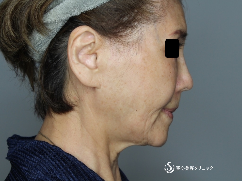 【70代女性・頬～顎下～首のたるみ治療】プレミアムミニリフト＋ネックリフト（術後1か月） Before 