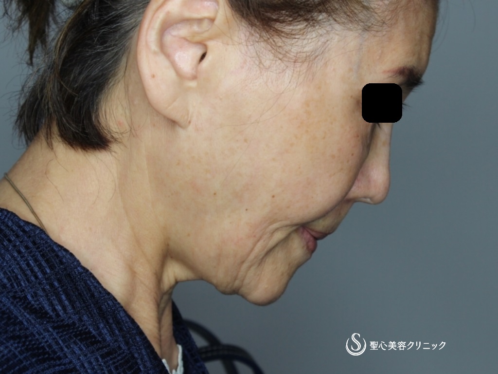 【70代女性・頬～顎下～首のたるみ治療】プレミアムミニリフト＋ネックリフト（術後1か月） Before 
