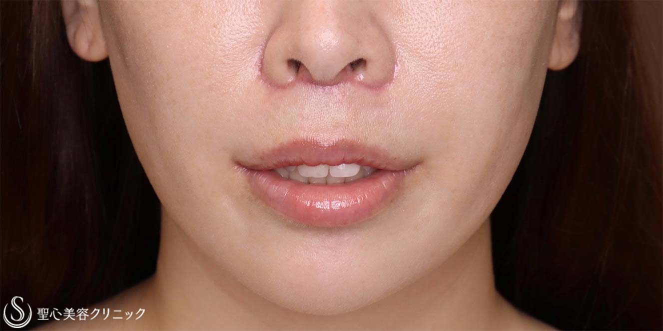【30代女性・人中を短くしたい！！】プレミアムリップリフト（プレミアム人中短縮術）＋プレミアム口角挙上術（術後1ヶ月） After 