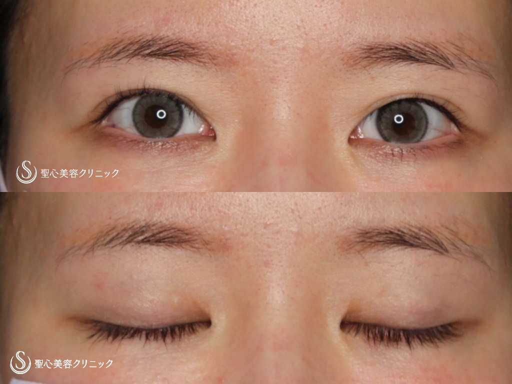 【20代女性・目の上のたるみ取り】二重埋没法後二重切開（術後5か月） Before 