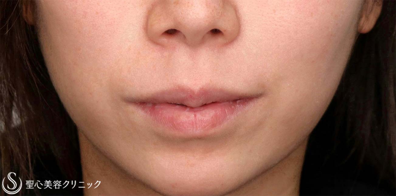 【30代女性・人中をできるだけ短くしたい！！】プレミアムリップリフト（プレミアム人中短縮術）（術後6ヶ月） Before 
