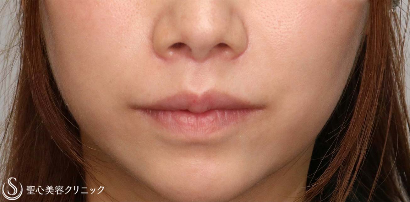 【30代女性・人中をできるだけ短くしたい！！】プレミアムリップリフト（プレミアム人中短縮術）（術後6ヶ月） After 