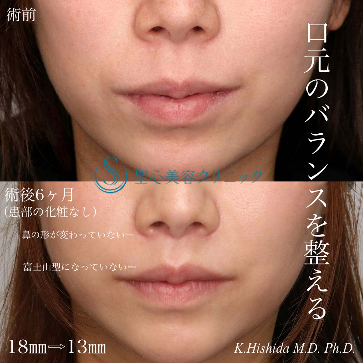 【30代女性・人中をできるだけ短くしたい！！】プレミアムリップリフト（プレミアム人中短縮術）（術後6ヶ月） After 