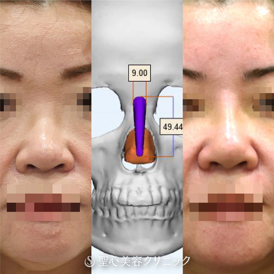 【50代女性・骨の形にフィットしたプロテーゼを作成】３Dオーダープロテーゼ＋耳介軟骨（1週間後） Before 