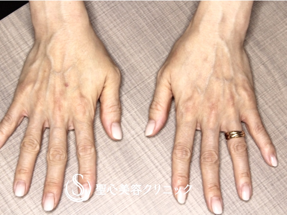 【50代女性・手の甲の血管を目立たなくする】プレミアムPRP皮膚再生療法（3か月後） Before 
