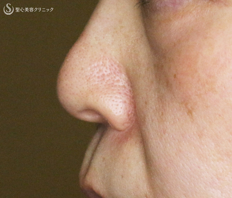 【50代女性・コンプレックス解消】小鼻縮小術+α法「Ver.3」（6年後） After 