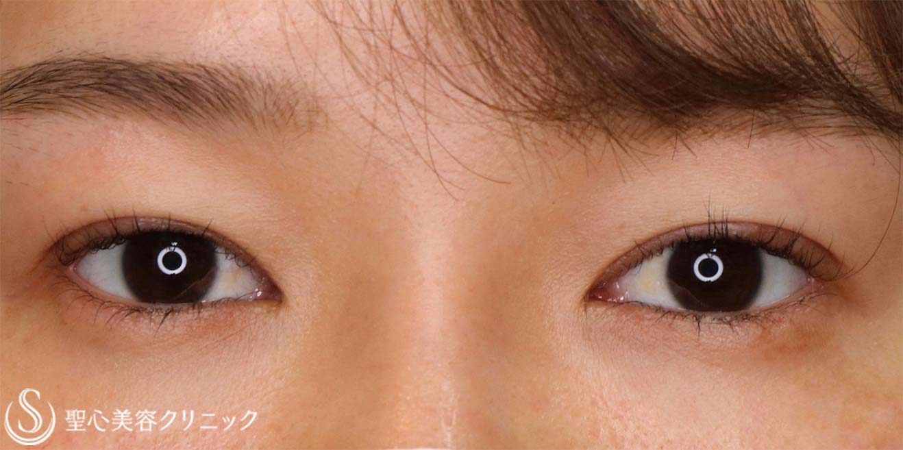 【30代女性・目を大きくパッチリに！！】眼瞼下垂（切開法/挙筋前転法）（術後8ヶ月） After 