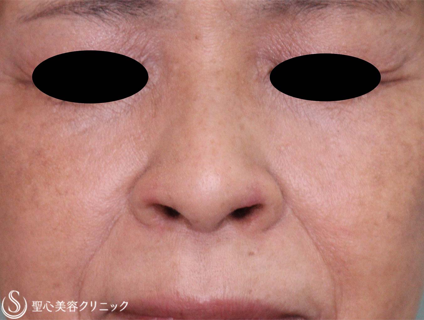 【60代女性・鼻孔の形】鼻孔縁下降術（術後6日、1か月） After 