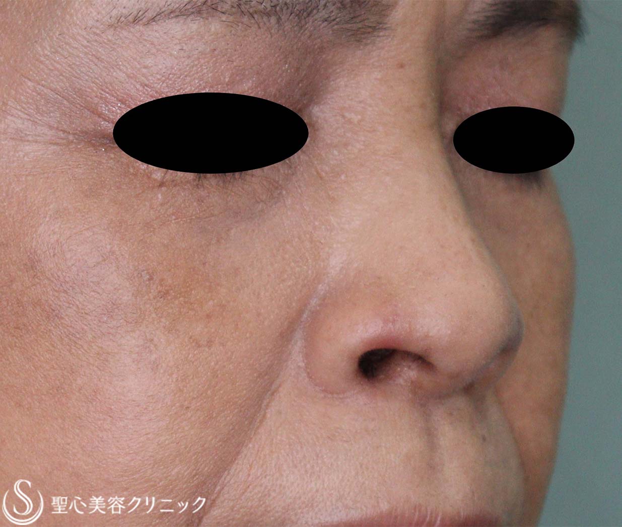 【60代女性・鼻孔の形】鼻孔縁下降術（術後6日、1か月） After 