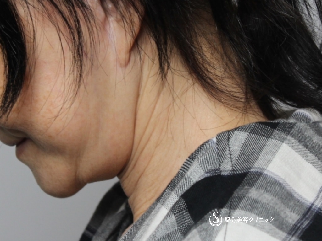 【60代女性・首のたるみをスッキリ】ネックリフト（1ヶ月後） Before 