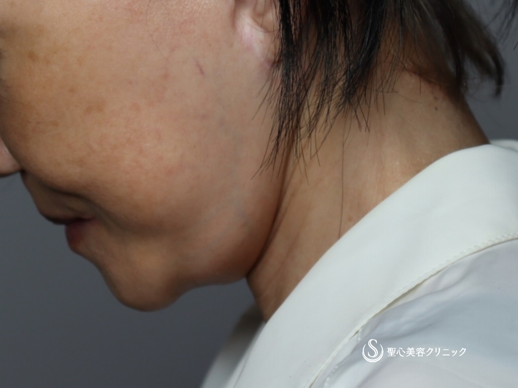 【60代女性・首のたるみをスッキリ】ネックリフト（1ヶ月後） After 