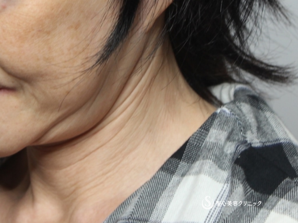【60代女性・首のたるみをスッキリ】ネックリフト（1ヶ月後） Before 