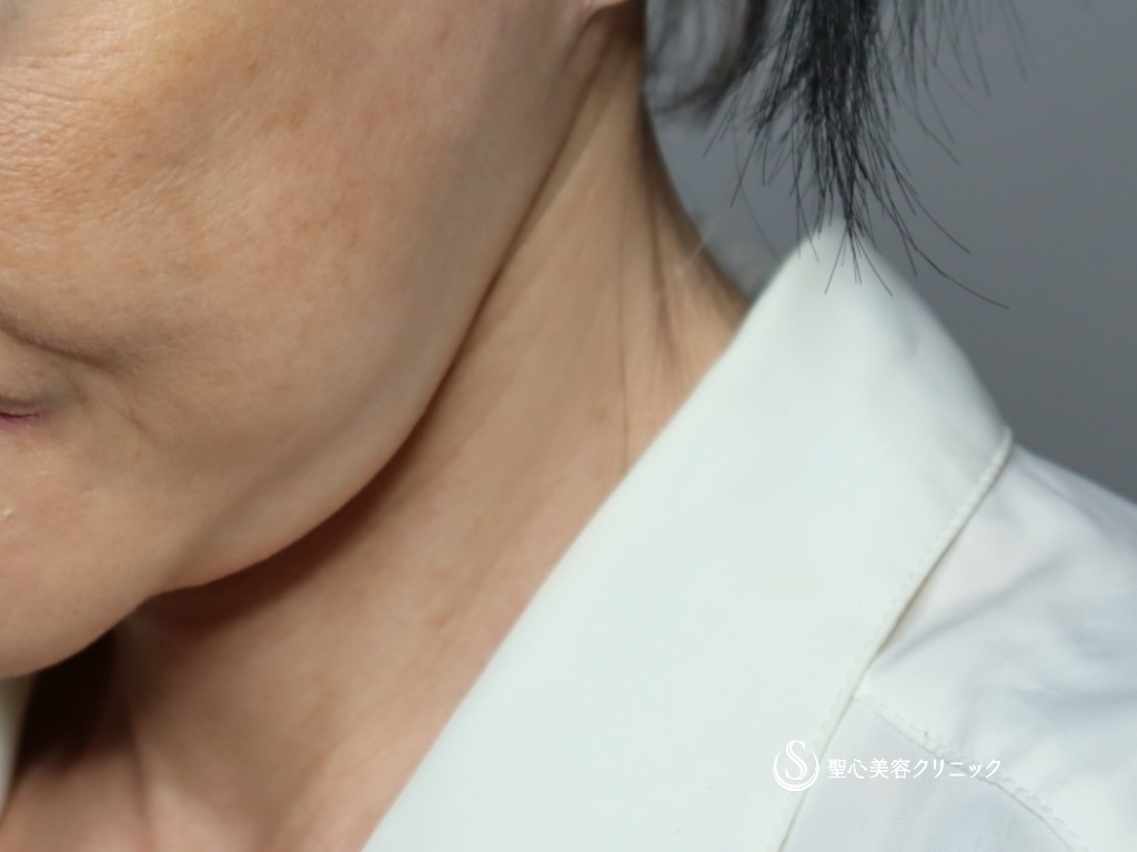【60代女性・首のたるみをスッキリ】ネックリフト（1ヶ月後） After 