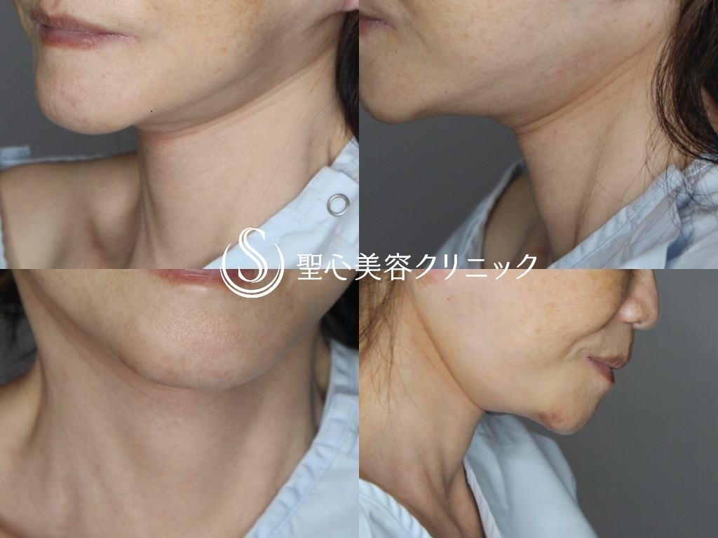 【60代女性・首のたるみをスッキリ】ネックリフト（1ヶ月後） After 