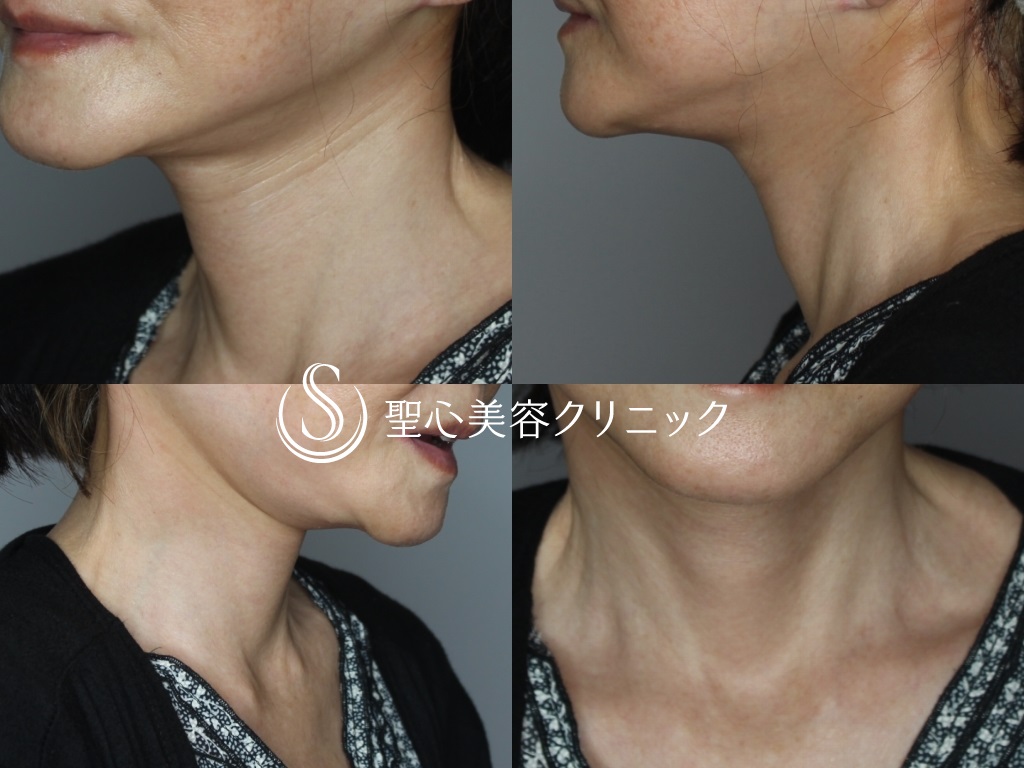 【60代女性・首のたるみをスッキリ】ネックリフト（1ヶ月後） After 