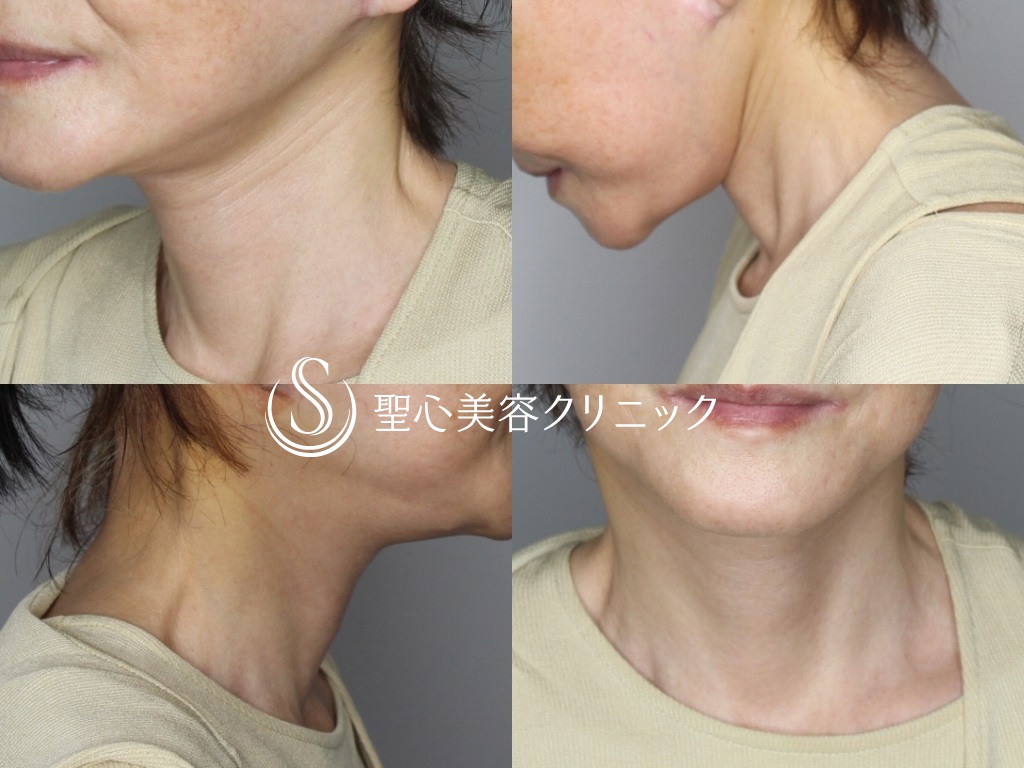 【60代女性・首のたるみをスッキリ】ネックリフト（1ヶ月後） After 