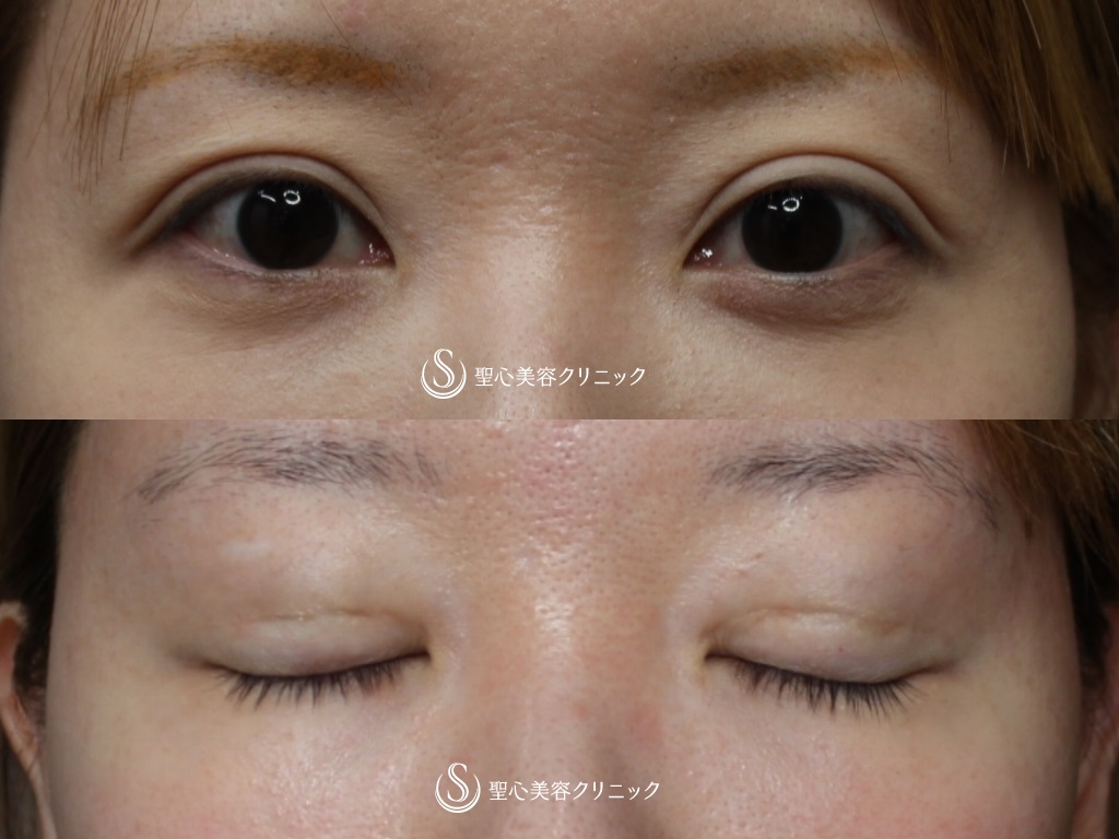 【30代女性・平行二重を強調】右側目頭切開、左目上切開（1ヶ月後） Before 