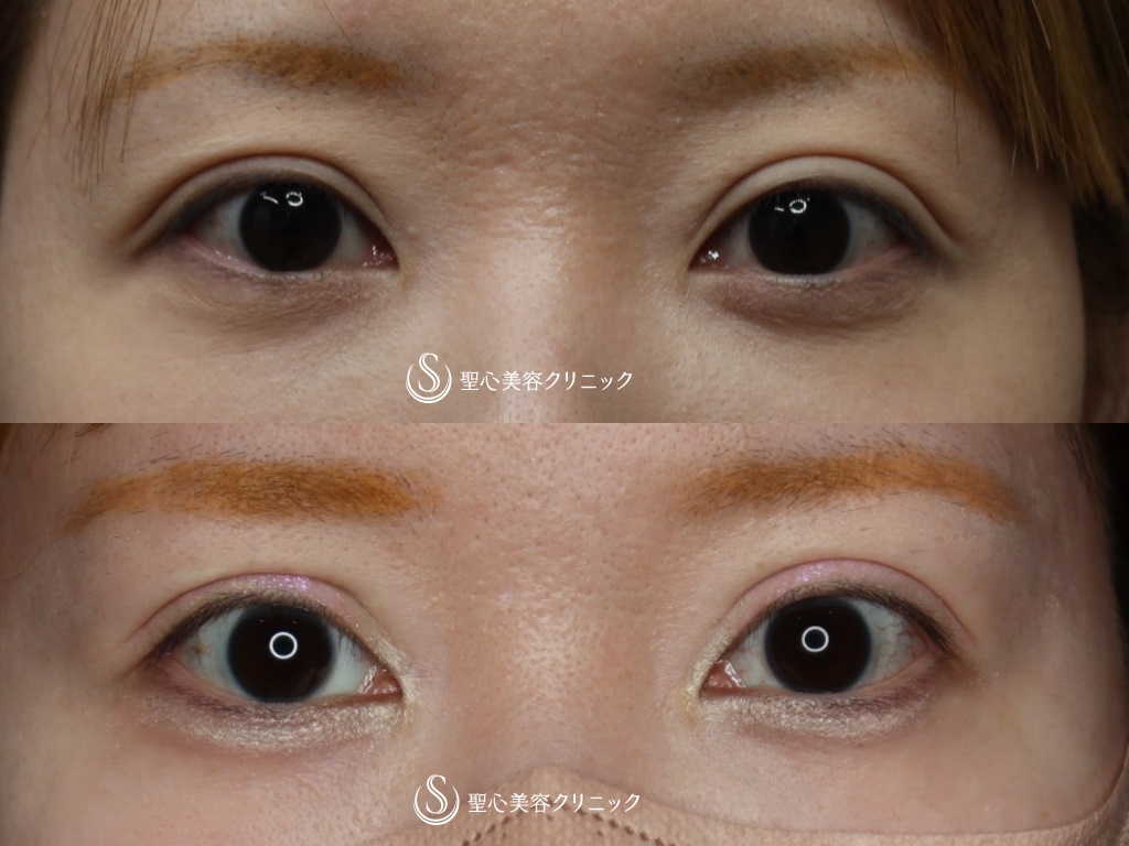 【30代女性・平行二重を強調】右側目頭切開、左目上切開（1ヶ月後） After 