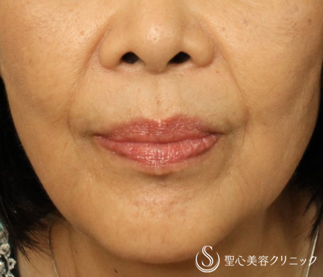 【70代女性・ほうれい線】プレミアムPRP皮膚再生療法（10年後） Before 
