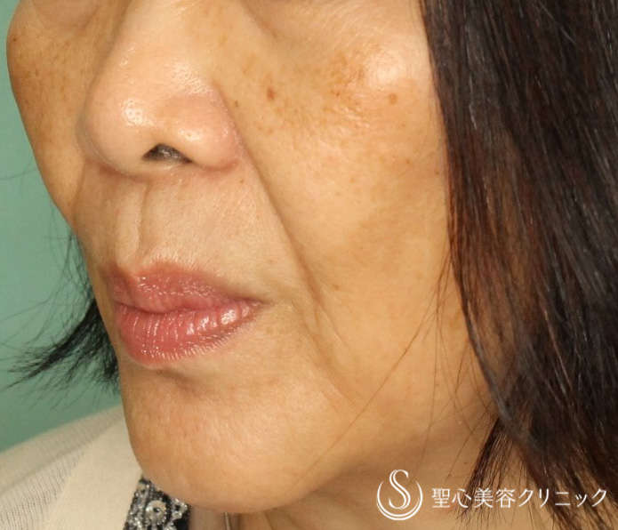 【70代女性・ほうれい線】プレミアムPRP皮膚再生療法（10年後） Before 