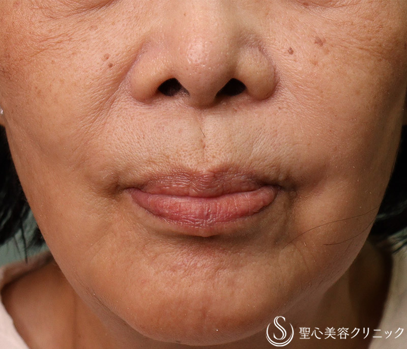 【70代女性・ほうれい線】プレミアムPRP皮膚再生療法（10年後） After 