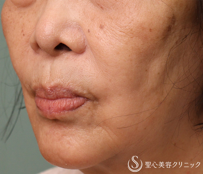 【70代女性・ほうれい線】プレミアムPRP皮膚再生療法（10年後） After 