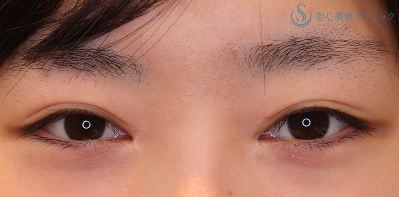 【20代女性・平行型のナチュラルで大きなパッチリ目にしたい！！】眼瞼下垂（切開法/挙筋前転法）（術後6ヶ月） Before 