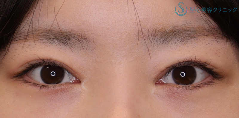 【20代女性・平行型のナチュラルで大きなパッチリ目にしたい！！】眼瞼下垂（切開法/挙筋前転法）（術後6ヶ月） After 