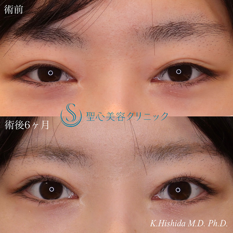 【20代女性・平行型のナチュラルで大きなパッチリ目にしたい！！】眼瞼下垂（切開法/挙筋前転法）（術後6ヶ月） After 