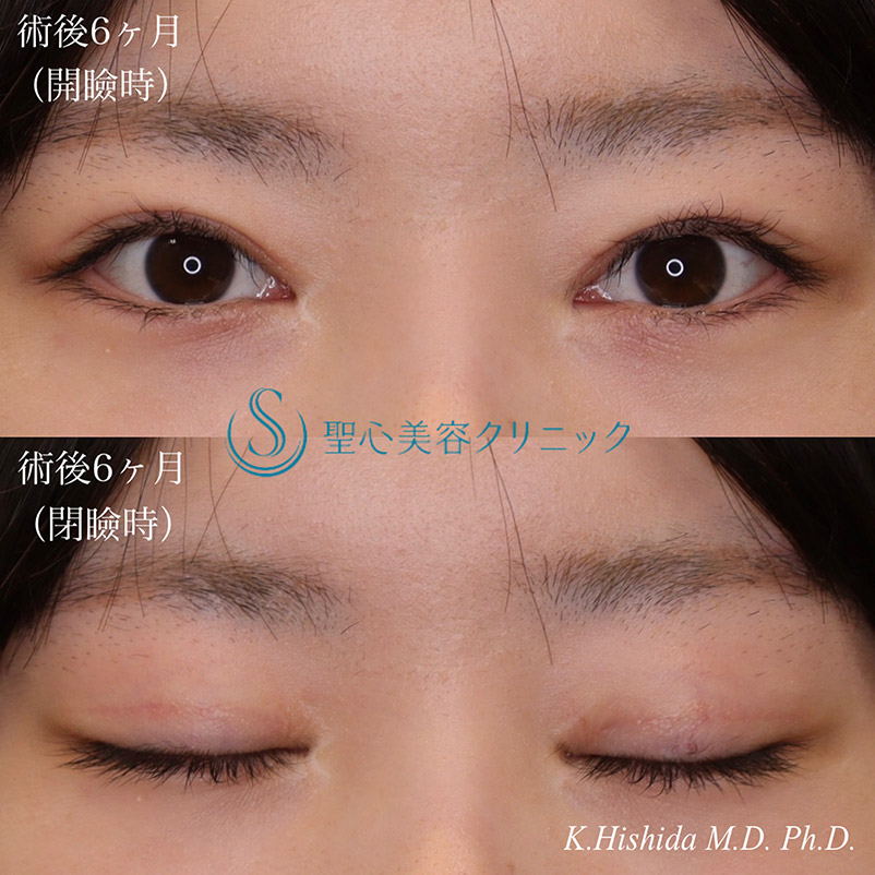 【20代女性・平行型のナチュラルで大きなパッチリ目にしたい！！】眼瞼下垂（切開法/挙筋前転法）（術後6ヶ月） After 