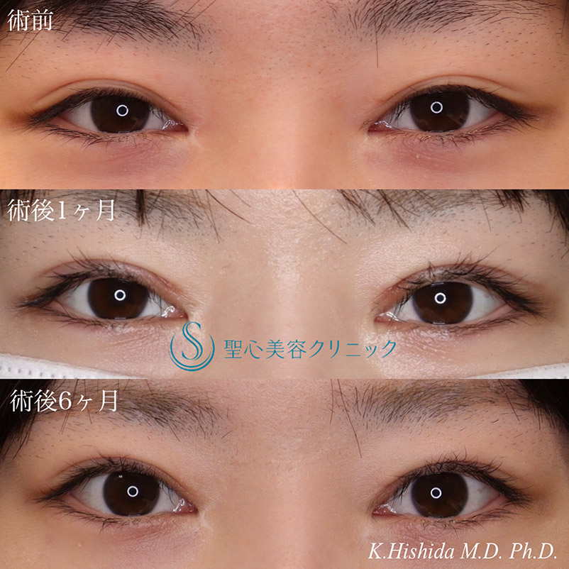 【20代女性・平行型のナチュラルで大きなパッチリ目にしたい！！】眼瞼下垂（切開法/挙筋前転法）（術後6ヶ月） After 