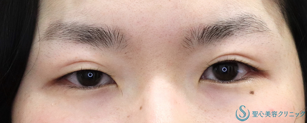 【20代女性・目の開きを改善】 眼瞼下垂（切開法/腱膜縫縮法）（半年後） Before 