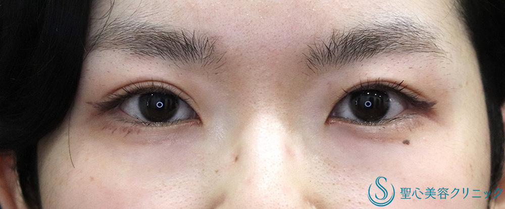 【20代女性・目の開きを改善】 眼瞼下垂（切開法/腱膜縫縮法）（半年後） After 