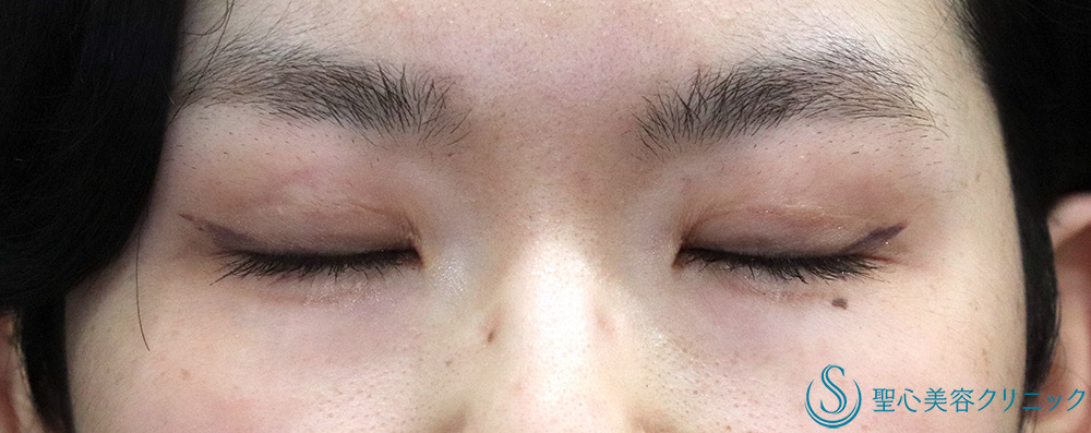 【20代女性・目の開きを改善】 眼瞼下垂（切開法/腱膜縫縮法）（半年後） After 